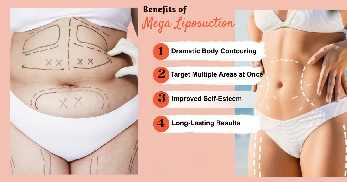 Benefits of Mega Liposuction in mumbai by Dr. Vinay Jacob